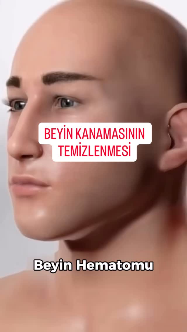 En basit şekli ile beyin kanaması kafatası kaldırılarak nasıl temizleniyor?Bu aciliyet gerektiren hayati ameliyatı en basit şekli ile anlatmaya çalıştım.Benzer eğitim videolarını bekleyenler beğenmeyi, kaydetmeyi ve paylaşmayı unutmasın 🙏😍#beyinkanaması #beyincerrahı #ameliyat #animasyon #opdrkerembikmaz