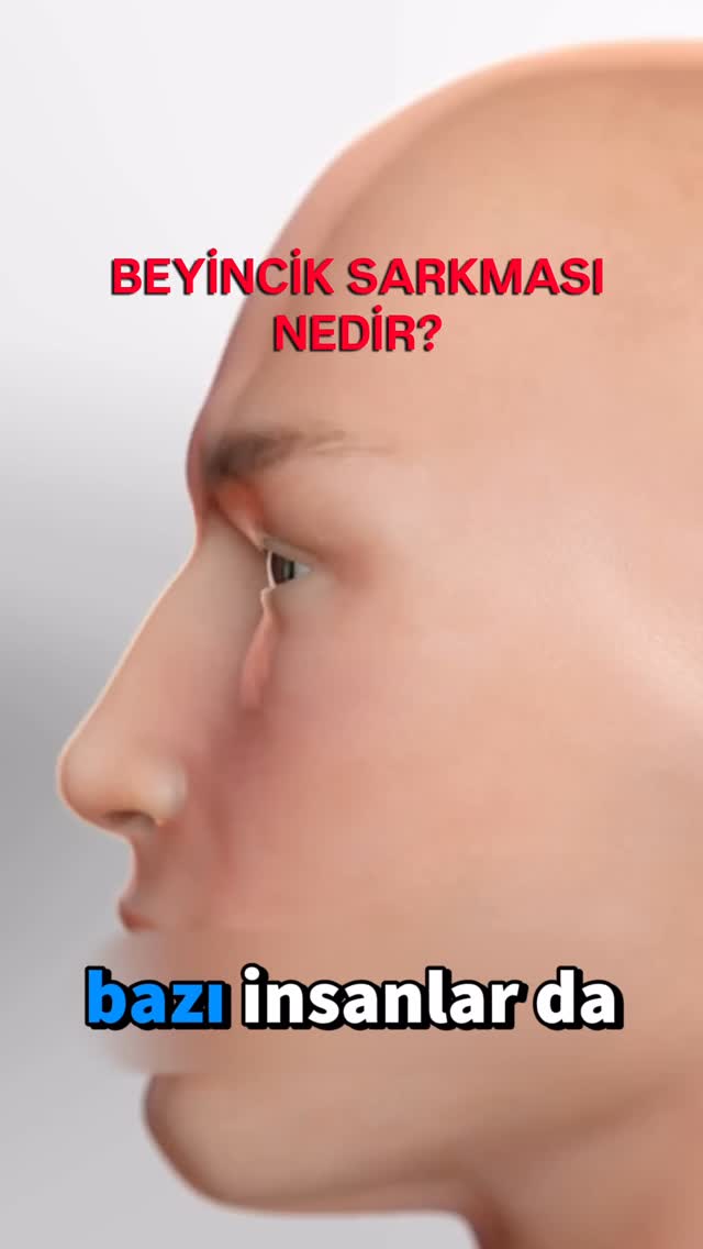 Beyincik sarkması (Chiari malformasyonu), beynin alt kısmının kafatasının altındaki açıklıktan aşağı doğru yer değiştirmesiyle ortaya çıkar.Baş ağrısı, ense ağrısı, denge problemleri, kollarda uyuşma ve bazen yutma güçlüğü gibi şikâyetlere neden olabilir.Tedavide amaç; beyin dokusu üzerindeki baskıyı azaltmak ve omurilik sıvısının normal dolaşımını yeniden sağlamaktır. Bunun için bazı hastalarda cerrahi tedavi gerekebilir.Erken tanı ve doğru değerlendirme, yaşam kalitesini belirgin şekilde etkileyebilir.#beyinciksarkması #chiarimalformasyonu #beyincerrahisi #nöroşirürji #başağrısı