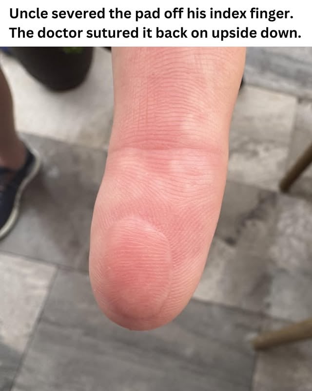 Reddit user krtomasko allowed me to share this image of their uncle’s index finger after the fingertip pad was severed and reattached. I am still waiting to hear back from krtomasko on whether the pad was intentionally reattached in a different orientation or if it was attached that way by mistake. After looking into this more, it is sometimes done intentionally but more likely it was an accident. I will keep you updated once he answers. ✨Follow for more✨ I am famous biologist. ⚠️ #science #medicine by @biologistmichael